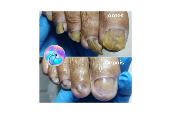 Foto de antes e depois do tratamento 31